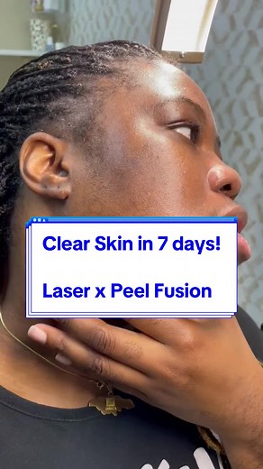 Clearing acne, dark spots & hair at the same time 🔥🔥 SAVE $150 What did she do? Advanced Treatment | 360 Laser x Peel Fusion Why? To correct hyperpigmentation, reduce acne breakouts and get rid of unwanted facial hair. 360 Approach ✨ combination medical therapy for maximum skin health restoration with expedited results in 7 days! This protocol does have a little down time of 5-7 days. It is best to schedule after a trip and not before. Schedule your transformation at www.360envy.com📍 BALTIMOR