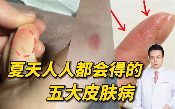 夏天这五大皮肤病，你起码中三个！脚气、痘痘、汗疱疹、皮炎、丘疹性荨麻疹这条视频教会你如何处理