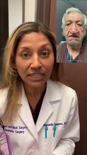 Rhinophyma treatment result with #drcampano #rhinophyma #plasticsurgeon #plasticsurgeonsoftiktok #results