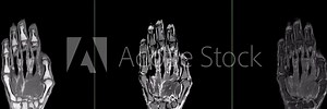 MRI Imaging of Hand Lesion: A clear view of the hand’s subcutaneous lesion is captured in this MRI footage, aiding in the identification and assessment of infiltrative conditions.