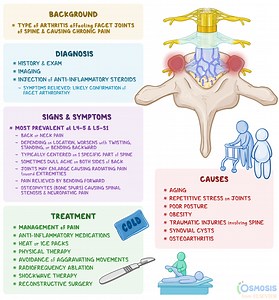 Facet Arthropathy: What Is It, Causes, Signs and Symptoms, and More | Osmosis