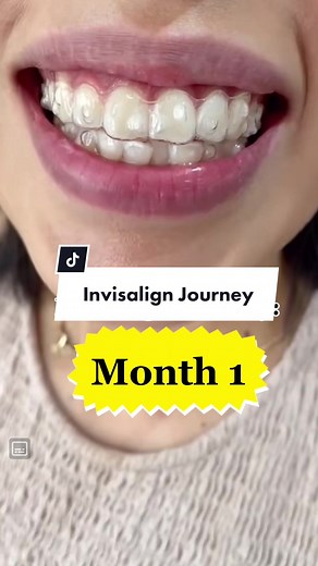 Invisalign Journey: Watch the Transformation Here!