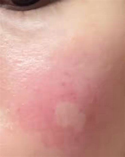 皮膚科行ってきました！多くの方が仰っていた通り、蚊刺過敏症（蚊アレルギー）の疑いが非常に高いという診断でした。腫れは落ち着きましたが、赤みと熱感はまだあり、右目も若干開きにくい気がします。とりあえず処方されたステロイド外用薬を塗って、1週間後にまた受診する予定です。