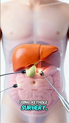Gallbladder Removal Cholecystectomy Procedure, Recovery & Benefits