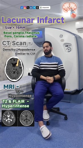 Anis Qureshi 🍁 | Lacunar Infarct Explained | Small Lesion, Big Clinical Impact 🧠 From definition → CT density → MRI signal intensity, everything simplified... | Instagram