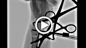 Acu-Loc 2 Volar Distal Radius Plate and Volar Tilt Correction Cadaveric Surgery with Dr. Ruch