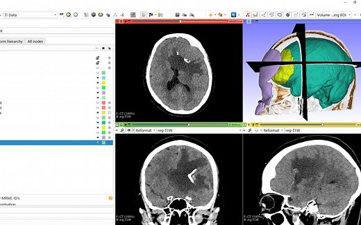 3D-slicer肿瘤建模