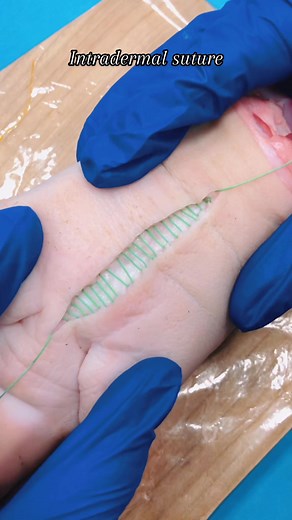 Baby steps in intradermal suture ✨ #suture #suturepractice #surgicalskills #intradermalsuture #healing #medicine #noscar #futuredoctor