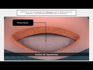 GUIDE DE L’EXTERNE POUR LES OPÉRATIONS DE CÉSARIENNE À LA MATERNITÉ DE BEAUMONT À ROUBAIX