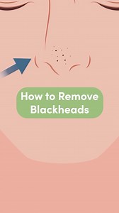 Looking for the best way to remove stubborn blackheads? Follow these tips to remove blackheads at home🧖‍♀️ #howto #lifehack #skin #skincare #blackheads #diy #beauty | wikiHow