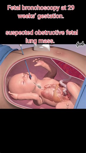 Fetal bronchoscopy at 29 weeks’ gestation. This allowed for diagnosis and management of a suspected obstructive fetal lung mass. Fetal lung masses, or fetal lung lesions, are defects that develop in the lungs before a baby is born. Some masses may be related to another congenital defect, or a genetic condition, but in most cases the mass is isolated. It is unknown why a baby's lung tissue doesn't develop normally.