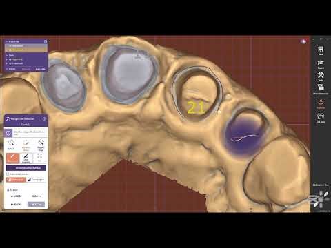 #exocadtoothmodeleditor 12 dissolved model create