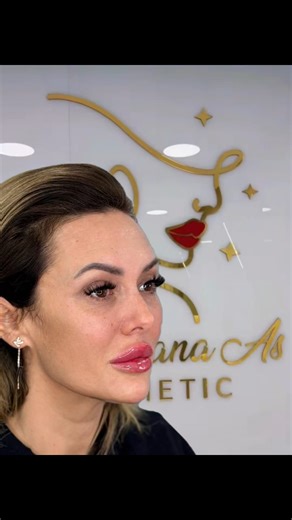 Dr.Roxana As AESTHETIC on Instagram: "Pachet Spring Glow Before - After by Dr. Roxana As ✅ Augmentare buze ✅ Alungire bărbie ✅ Botox 🫦💉Pachete PROMOȚIONALE Acid & Botox 🌸 Pachet SPRING GLOW: 2 ml AH (buze + bărbie sau pomeți) + 4 zone de botox + foxy eyes + Set Winter Glow Deluxe cu produse ultra-premium 🎁 - 2500 de lei redus de la 5000 de lei ✨ Pachet FULL-FACE: 1 ml AH + alungire bărbie + pomeți + rinocorecție cu AH + 4 zone de botox - 4500 de lei redus de la 7900 de lei ⚡️Pachet SUBLIME: 