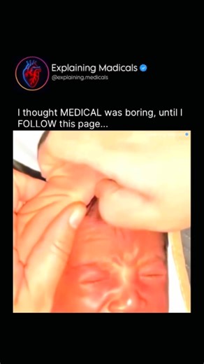 Medical | Health | Anatomy on Instagram: "A newborn baby pulling their own hair is usually normal and harmless, and it’s rarely a sign of a serious problem. Here’s what’s happening biologically and developmentally: 1. Newborn reflexes and poor control Babies are born with immature nervous systems. Their movements are mostly reflex-driven, not intentional. When a newborn’s hand brushes their head, the grasp reflex can cause them to clutch hair and pull without understanding pain or cause-and-effe