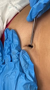 1.2M views · 2.3K reactions | Strange insect removed from belly This original video was produced by Rick Lax and Alex Z. | Crazy Clips & Silly Skits | Facebook