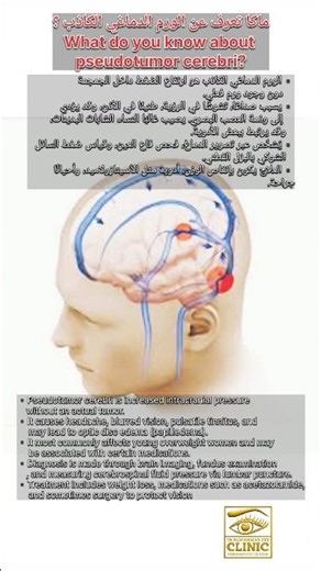 الورم الدماغي الكاذب pseudotumor cerebri #العين #طبيب_عيون #eyes #ophthalmology