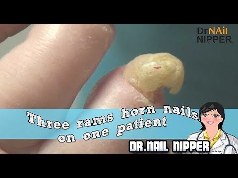 Three Rams Horn Nails on One Patient. Do you have one toenail? (2018)