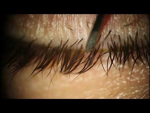 Ingrown Eyelash Cut Out with Needle