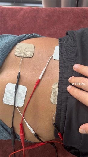 Trong vật lý trị liệu, dòng điện giao thoa (Interferential Current - IFC) được coi là một trong những " dòng tốt nhất" để giảm đau thắt lưng cấp tính nhờ khả năng tác động sâu mà không gây khó chịu cho người bệnh. Dưới đây là thông tin chi tiết về cơ chế, tác dụng và cách áp dụng phương pháp này: 👉1. Dòng điện giao thoa là gì? Dòng điện giao thoa được tạo ra bằng cách cho hai dòng điện xoay chiều trung tần có tần số hơi khác nhau (ví dụ: 4000Hz và 4100Hz) gặp nhau tại một điểm trong mô cơ thể. 