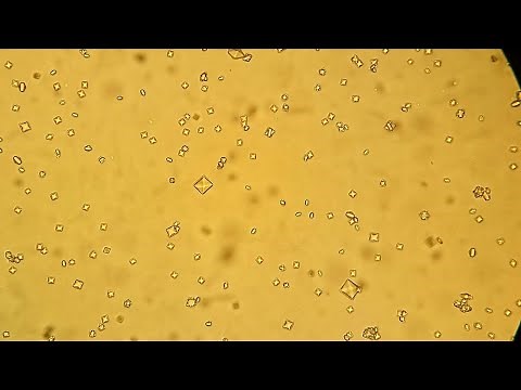 Calcium Oxalate crystals in urine microscopy.