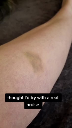 Does Foundation and Concealer Really Cover Bruises? A Test with Lavender Concealer