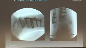 Pilon Fractures
