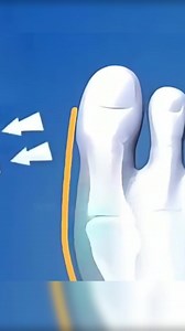 328 reactions · 17 shares | ✅ wyrównuje i podpiera palce stóp ✅ wygodny - można nosić jak skarpetki  dyskretny - noś w obuwiu ★ w zestawie 1 para (lewy + prawy) Kliknij https://vigoexpress.pl/produkt/ortopedyczny-aparat-na-haluksy-1-para-lewy-prawy-fixedfeet/?sp=7759i007 | Vigoexpress | Facebook