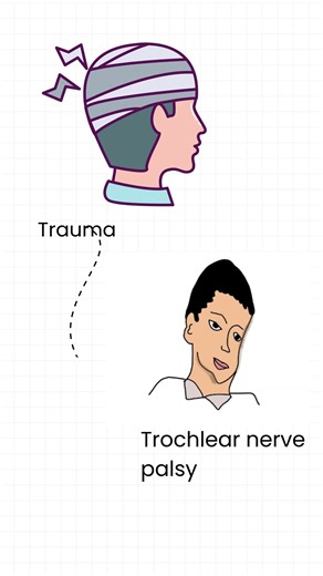 Why Trauma LOVES the Fourth Nerve