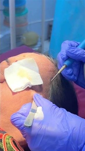 Cutaneous Horn removal by Electrocauterization