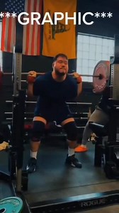 Guy Breaks His Forearm