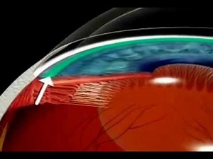 What is Glaucoma? Explained using Animation.