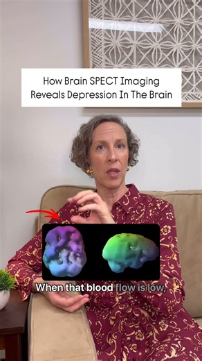 Amen Clinics on Instagram: "Depression isn’t just a feeling—it can actually show up in the brain! On a SPECT scan, we often see two classic patterns when someone has depression. ✨ Low Blood Flow to the Prefrontal Cortex ✨ The prefrontal cortex sits right behind your forehead and helps with decision-making, focus, and motivation. In some cases of depression, this area has low blood flow when the brain is at rest. When that happens, it can lead to low motivation and a low mood—making it harder to 