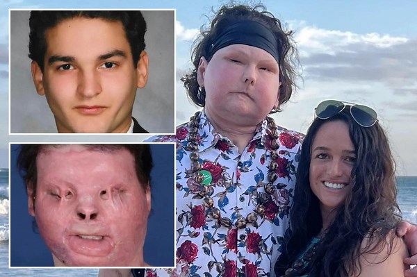I survived the first face and hand transplant to find love