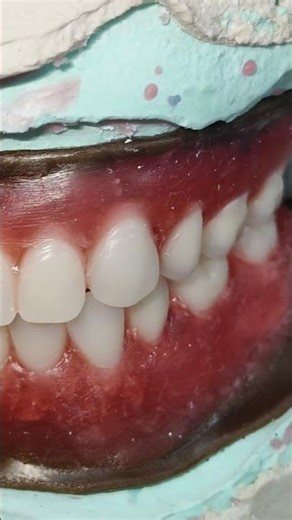 Missing teeth???#dentist #shorts #dentalclinic #clinic #prosthodontics