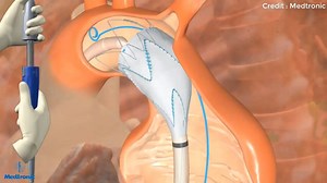 107K views · 345 reactions | Aortic Aneurysm Repair. | Medical Addicts | Facebook