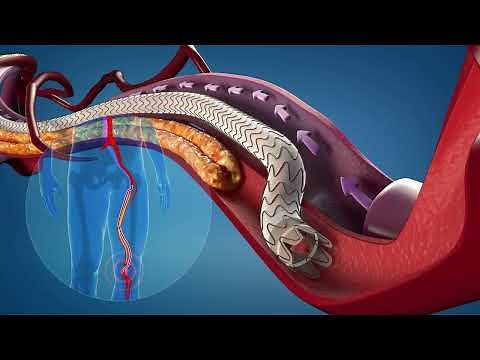 PTAB using the DETOUR System Procedure Animation_MM2589 US Rev 03