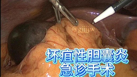 坏疽性胆囊炎-急诊手术治疗