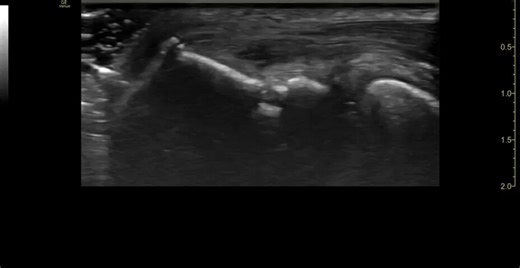 Lateral elbow enthesitis (common extensor tendon) in a patient with ankylosing spondylitis on a TNF inhibitor.Pearl:Not all OMERACT entheseal elementary lesions are equally important!-More specific 👉 erosions and 🔥power Doppler signal (especially ≤2 mm from cortex)-Less specific 👉 heterogeneity, calcifications and enthesophytes (can occur due to biomechanical loading/stress, esp. LE enthesis with high BMI)#MSKUS #RheumUS