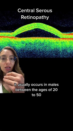 Intriguing Case of Central Serous Retinopathy