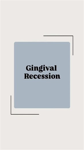 Dr. Neha Agarwal on Instagram: "Day 3 GINGIVAL RECESSION | MILLER CLASSIFICATION | PERIODONTICS | FINAL YEAR BDS . . . #DentalNotes #BDSLife #RevisionGuides #ExamHacks #studymotivation #fypppppppppppppppppppppppppppppppppppppppppppppppppppppppppppppppppppppp #instagood #trendingreels"