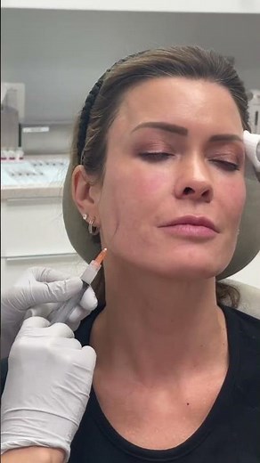 Sculptra: Poly-L-lactic Acid Injectable Biostimulator