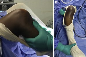 Single-Stage Arthroscopy-Assisted Reduction and Internal Fixation (ARIF) of Tibial Rim Fracture With Posterior Cruciate Ligament Reconstruction and Repair of Posterolateral Complex and Meniscal Injury