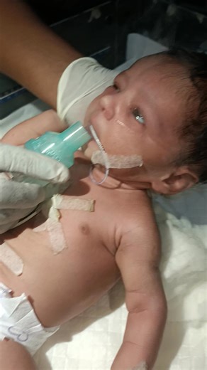 1.2M views · 79K reactions | Baby being steamed from nebulization  #youtubeshorts #viralreelschallenge #shortsreels #trandingreels #cutebaby #nursing #shortsvideos #fbreelsfypシ゚viralfbreelsfypシ゚viral #fbviralpost2025シ #arbaznicunursingstm #fbpost2025シfbreels #videoviralシviralシ2025 #fbreelsfypシ゚viralシ #viralpost2025シ | Arbaz NICU Nursing STM | Facebook