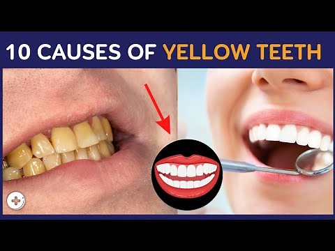 10 Causes Of Yellow Teeth And How To Avoid Them | Health Guideline