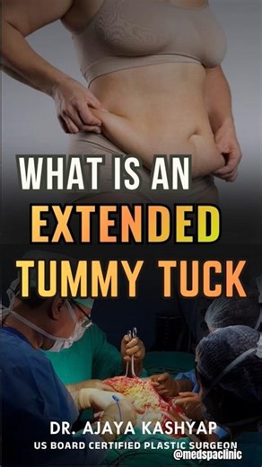 What is an Extended Tummy Tuck? | Quick Facts & Expert Tips #extended #tummytuck #shorts