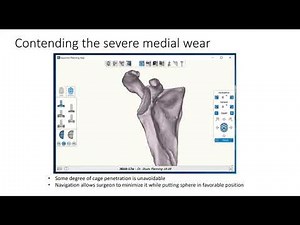 Exactech GPS Preoperative Planning Examples