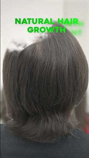 Hair Regrowth with GFC Treatment, Before & After Transformation 😳🔥