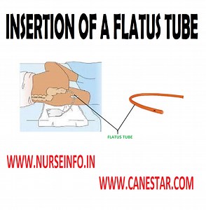 How do you insert a flatus tube? [2025] | QAQooking.wiki