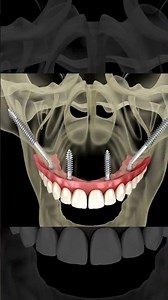 Advanced All-On-4 Dental Implants with Dr. Paul Anderson, an Oral Surgeon in Peachtree City, GA