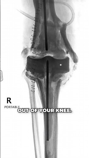 Eliminating Serious Complications After Knee Replacement⁉️